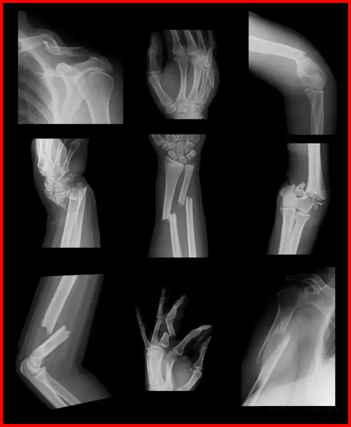 Different types of fractures