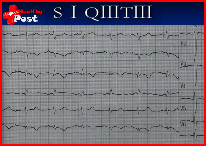 Electrocardiogram