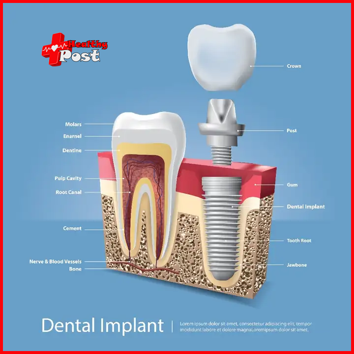 Dental implants