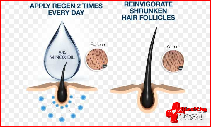 minoxidil beard