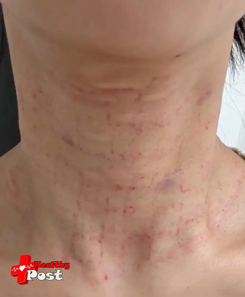 neck wrinkles