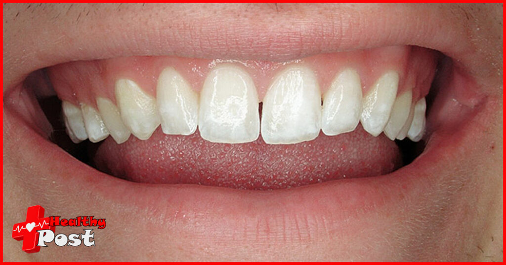 Dental Disease