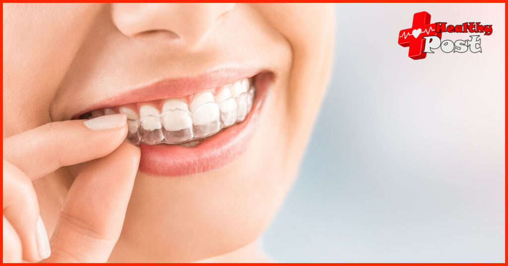Fixed Metal Braces