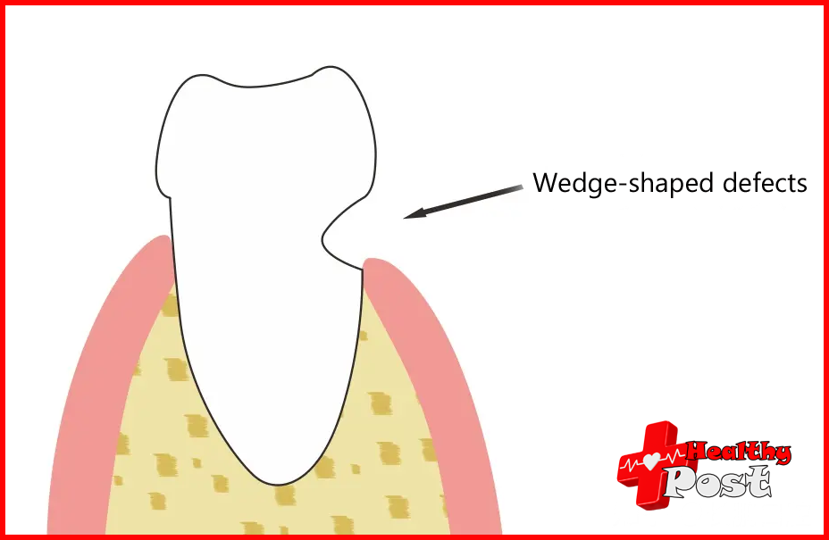 Wedge-shaped defects