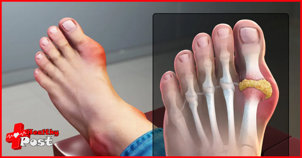 What are the causes of gout pain? Gout
