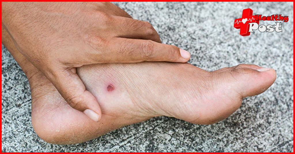 Skin Ulcer