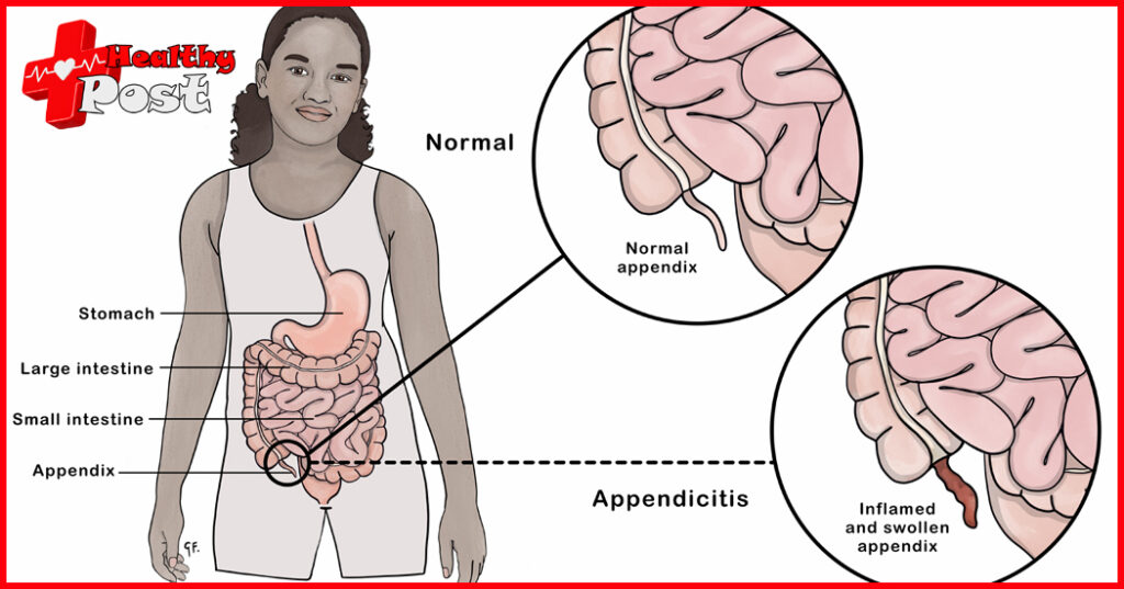 Does appendicitis require surgery? Can I do it without surgery? appendicitis