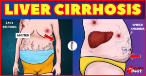 cirrhosis
