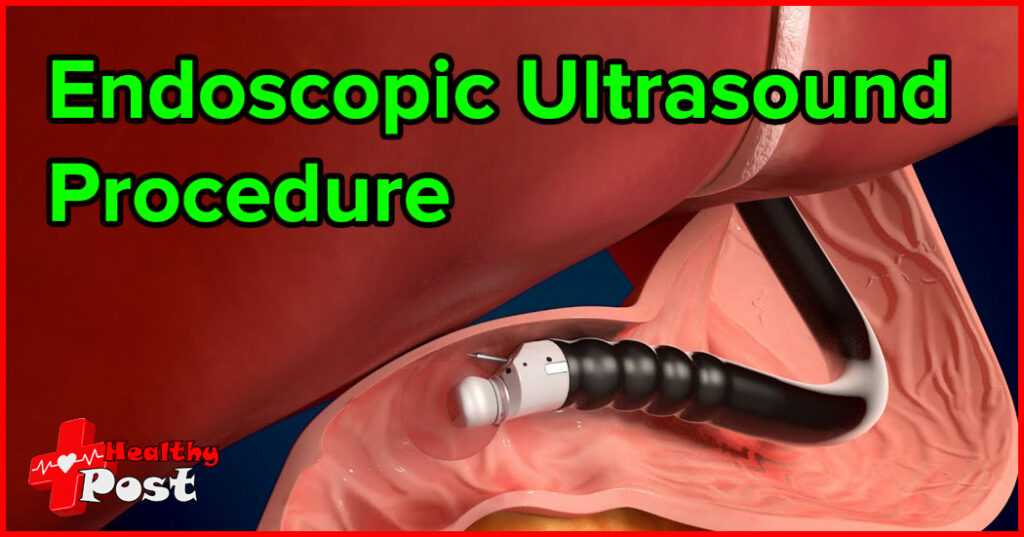 What Is Endoscopic Ultrasound Different From Colonoscopy And Gastroscopy