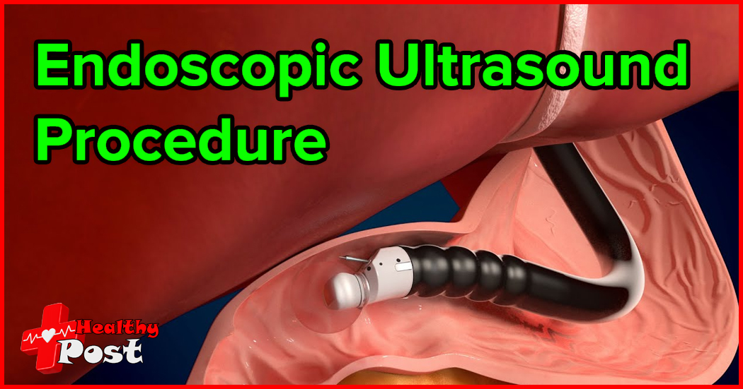 endoscopic ultrasound