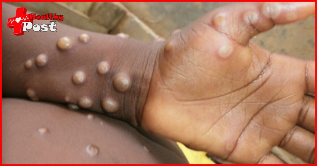 The initial monkeypox symptoms are similar to those of a cold. Learn more about monkeypox! monkeypox