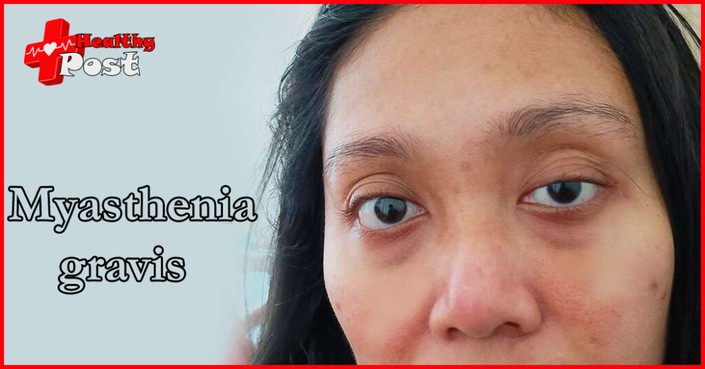 myasthenia gravis
