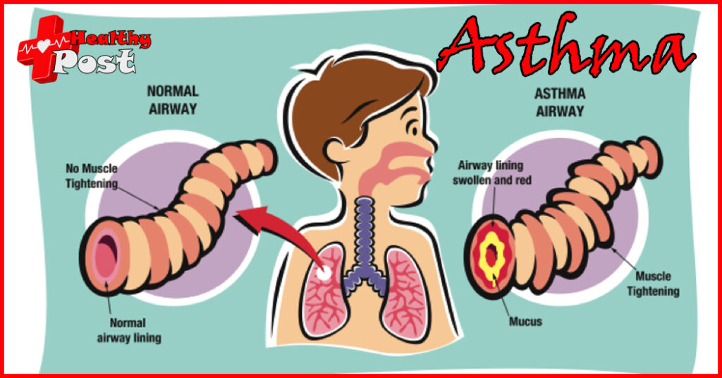 Asthma