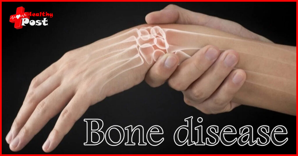 How much do you know about bone disease? Bone disease