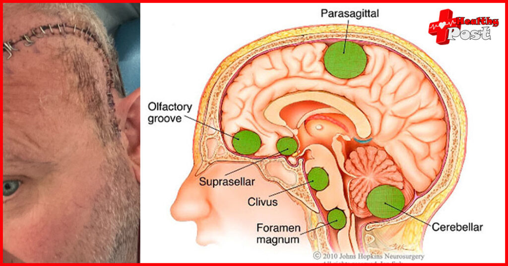 If these major signs of brain tumor appear, go to hospital quickly! Brain Tumor