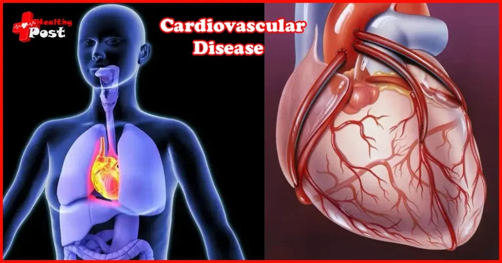 Cardiovascular Disease