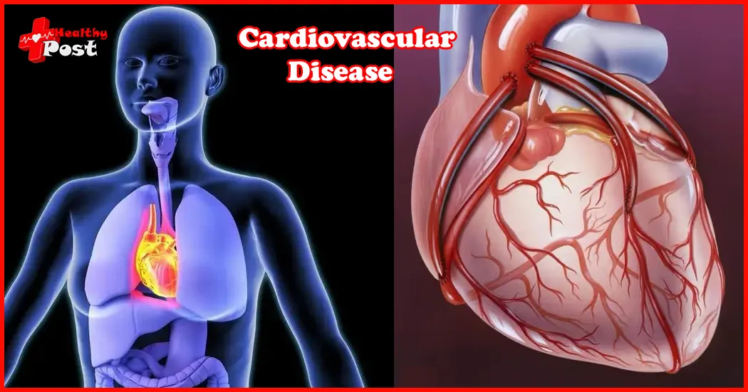 Cardiovascular Disease