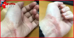 Eczema