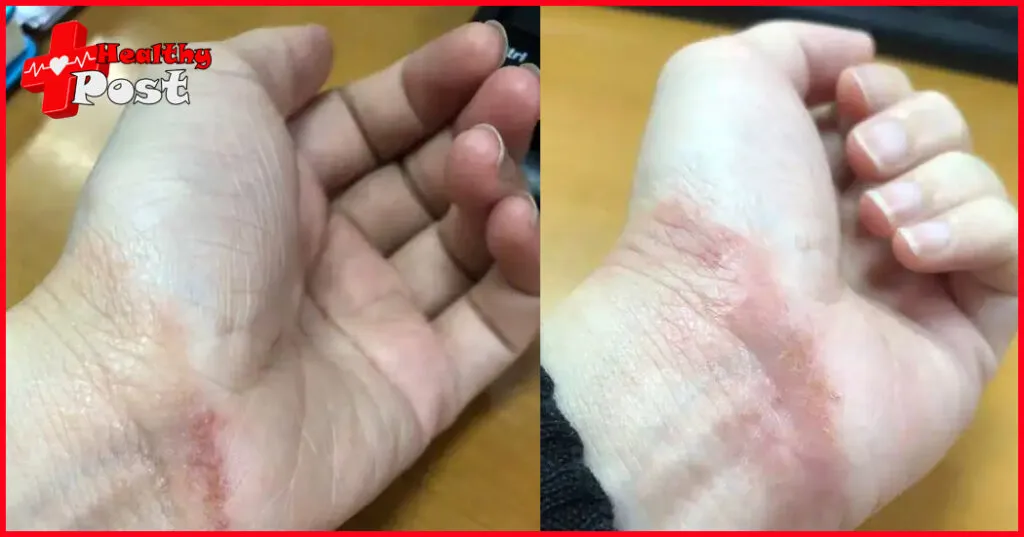 Eczema