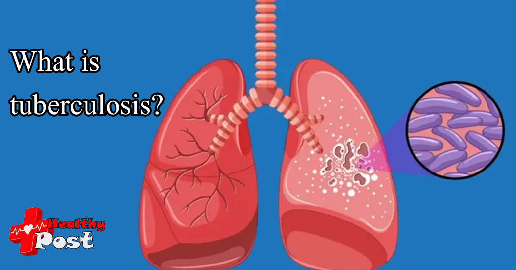 What is tuberculosis