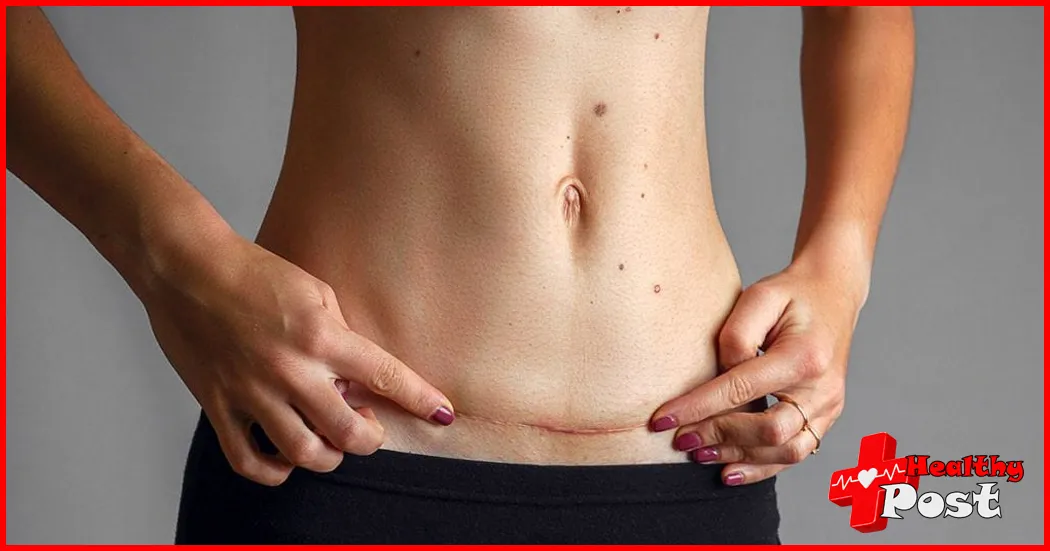 caesarean section