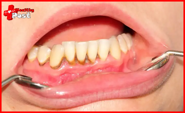 Dental plaque picture