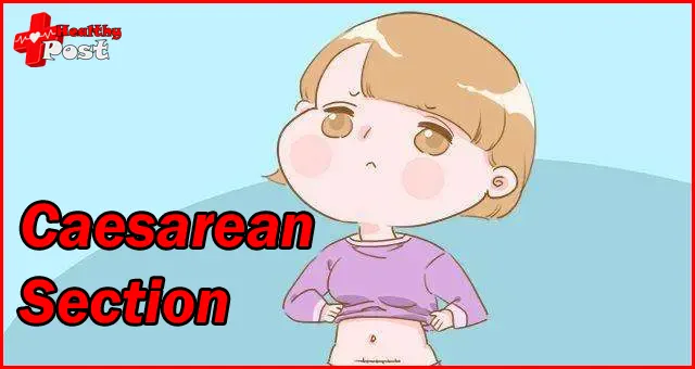 caesarean section