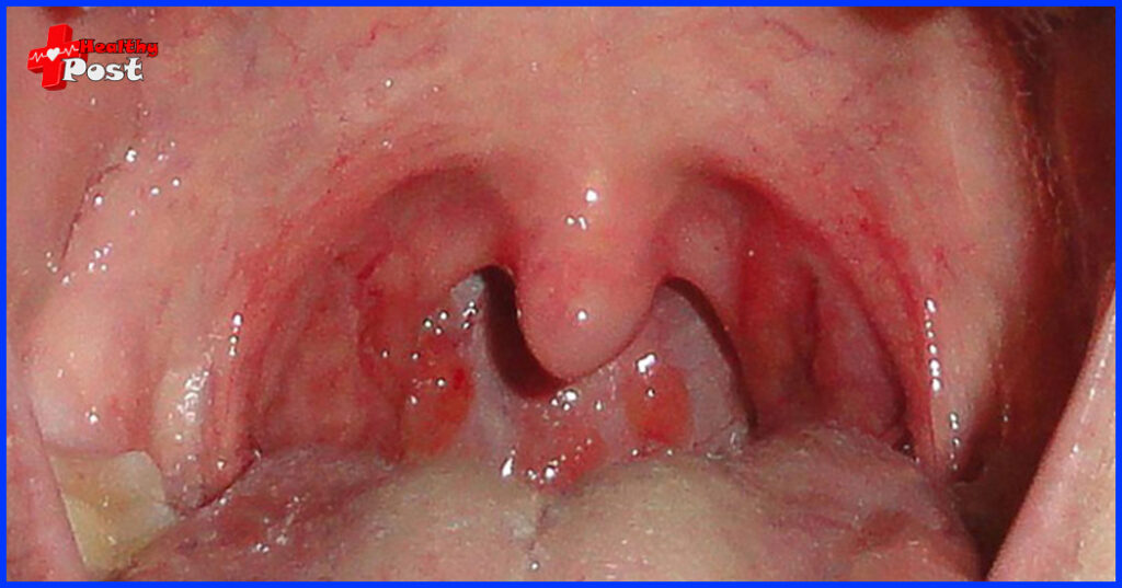 sore throat