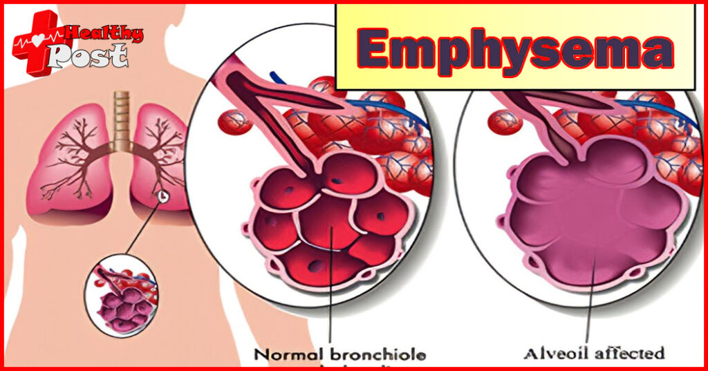 How to prolong life with emphysema, follow tips reduce attacks Emphysema