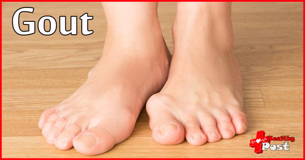 Gout Disease