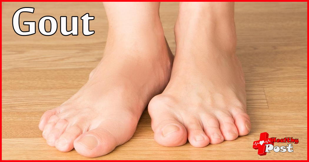 Gout Disease