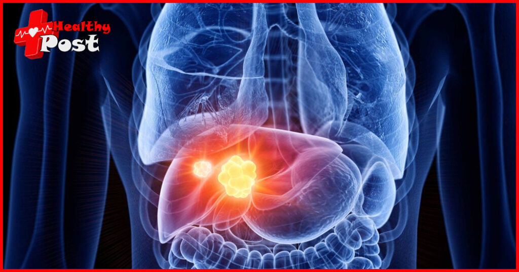 Liver cancer