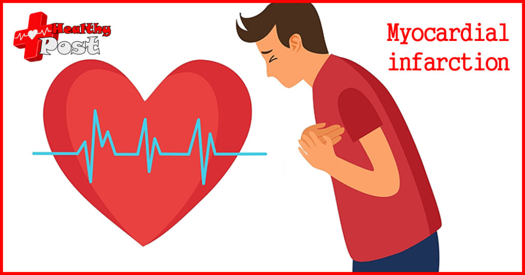 Myocardial infarction