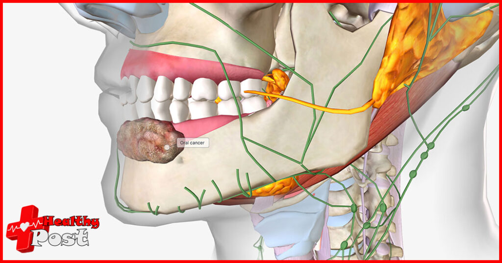Oral cancer