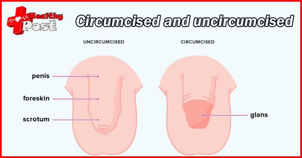 circumcision