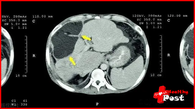File Photo of liver cancer