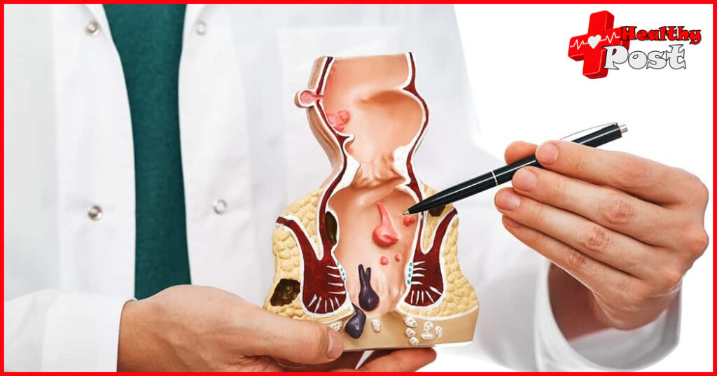 Understanding Anal Cancer: Causes, Symptoms, and Treatment Anal cancer