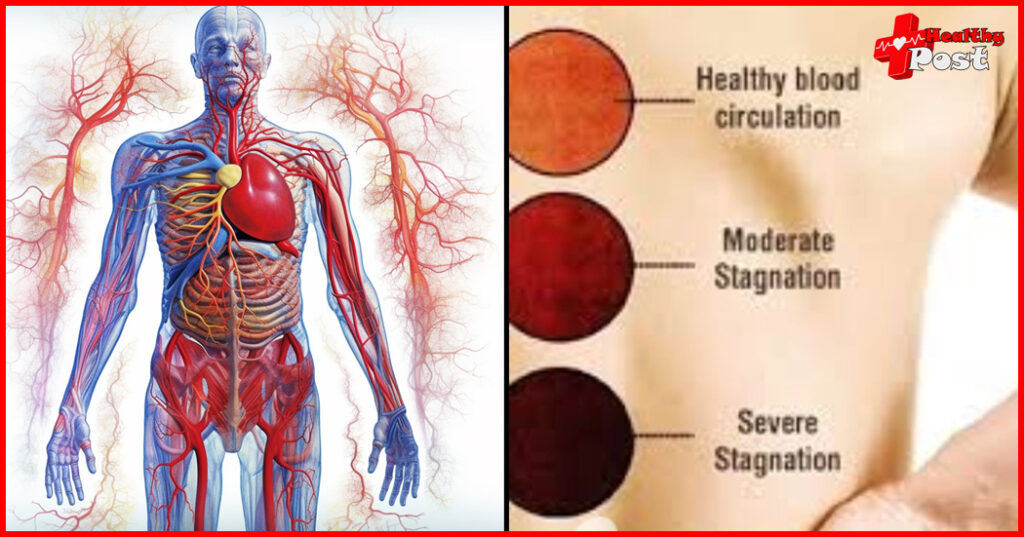 Blood stasis