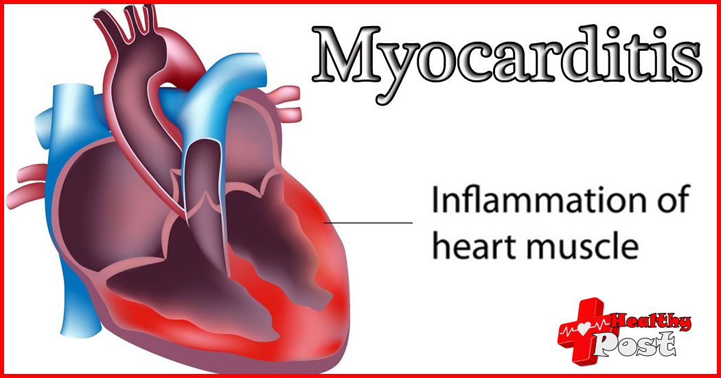 Myocarditis Supportive Therapy