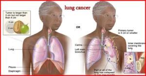 Non-Small Cell Lung Cancer ICD-10
