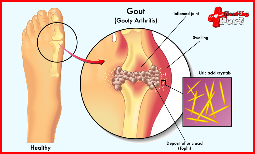 Gout