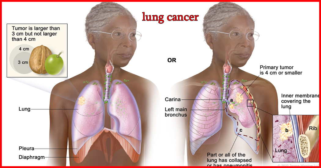 non small cell lung cancer icd 10