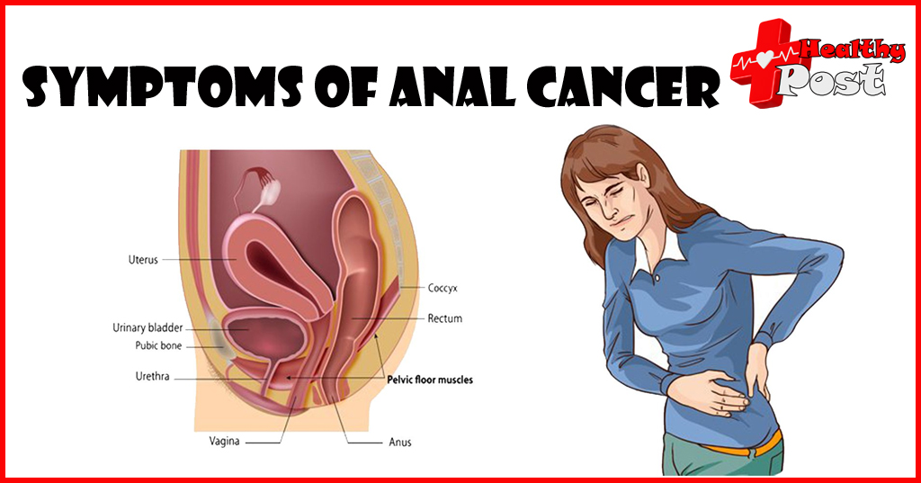 Anal Cancer