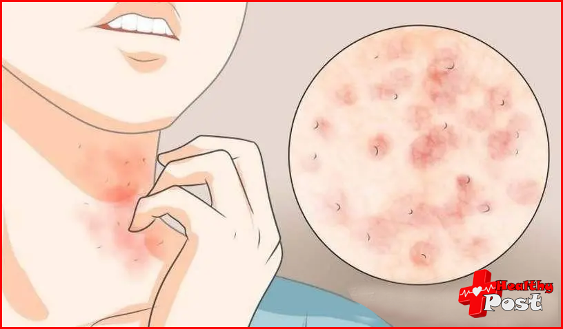 Allergy Skin diseases