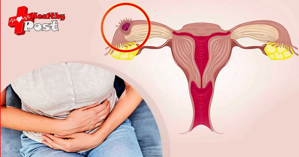 Ectopic pregnancy