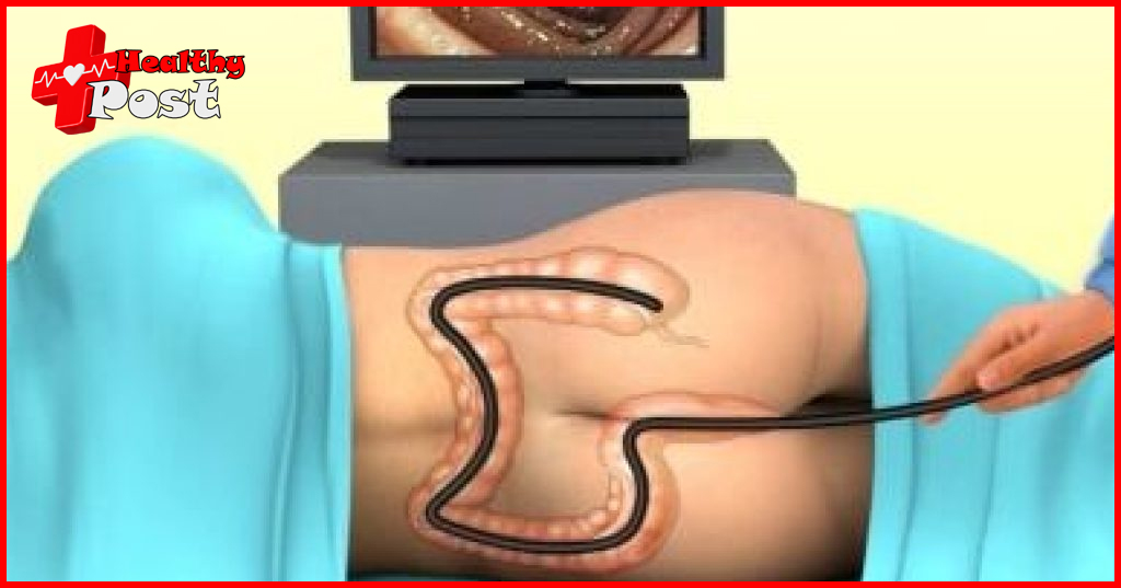 female colonoscopy