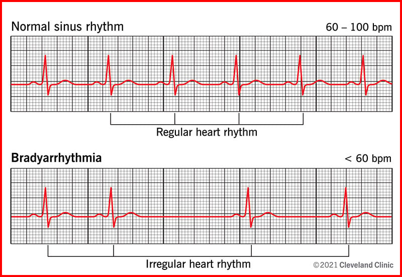 Bradyarrhythmia symptoms