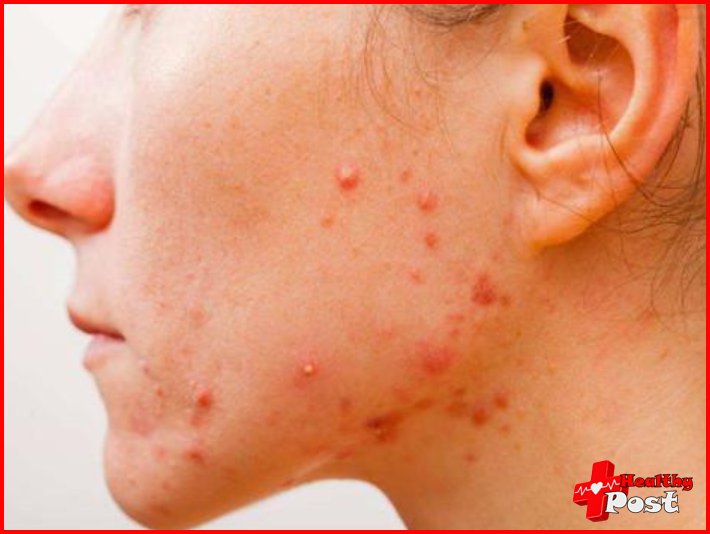 Clindamycin Phosphate Gel for acne