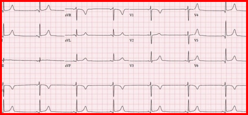 Bradyarrhythmia symptoms