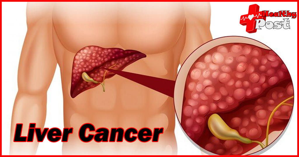 liver cancer